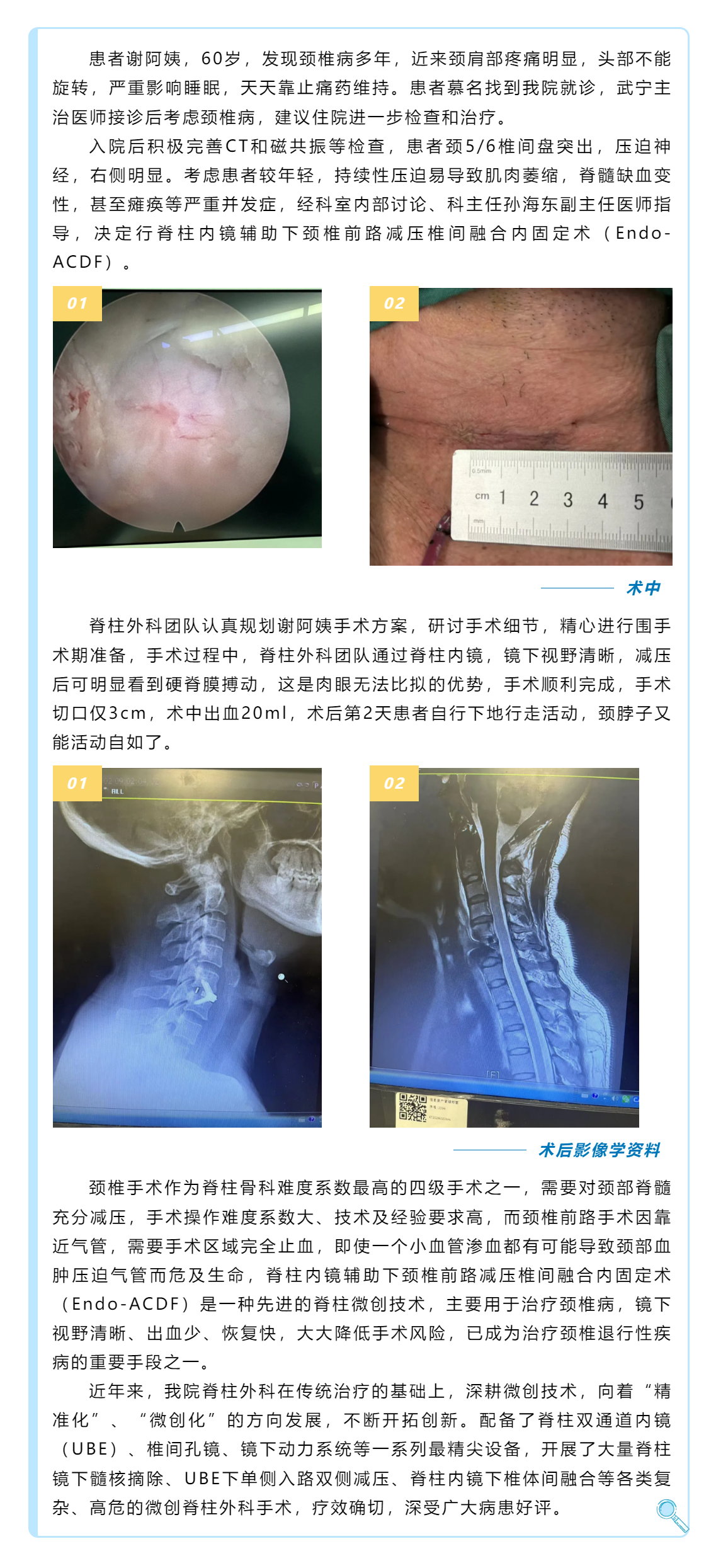 颈椎退行性疾病患者福音——颈椎前路减压椎间融合内固定术.png